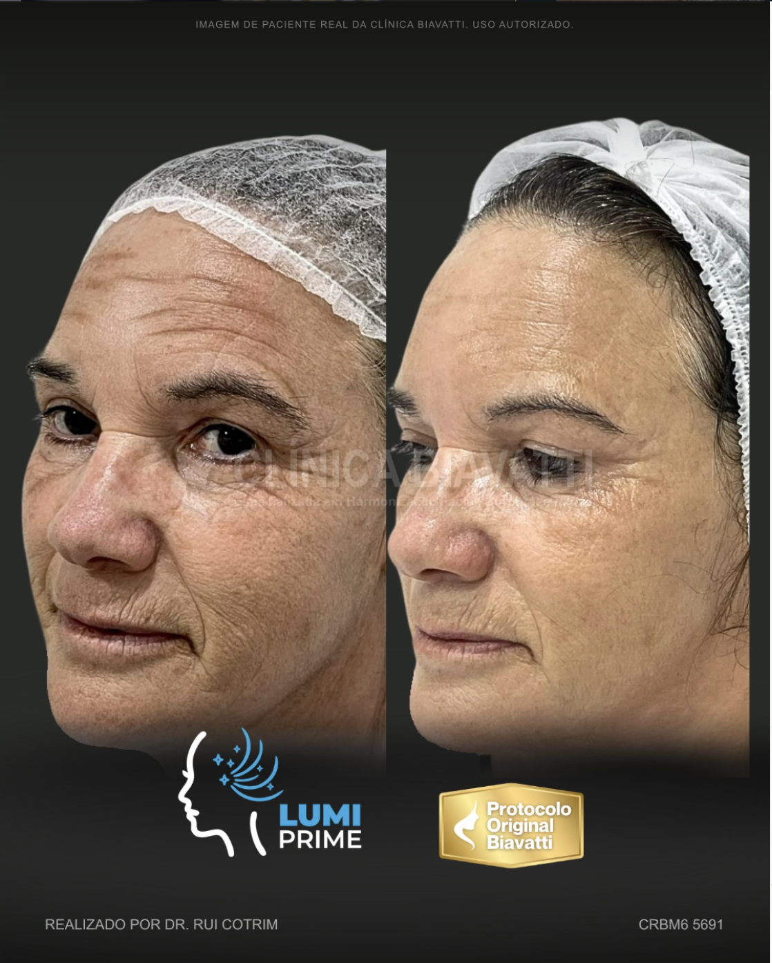 Caso real de tratamento Lumi Prime com protocolos exclusivos da rede Clínica Biavatti
